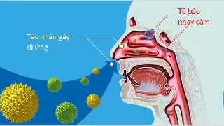 Phân biệt viêm mũi dị ứng và viêm xoang, cách điều trị